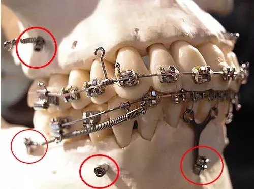 结构都能成为支抗,包括牙齿,部分牙弓,以及面或头颈等,都可以单独或