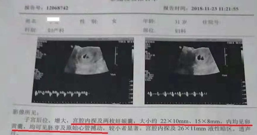 多囊患者两年未孕针灸助其自然怀孕喜得双胞胎