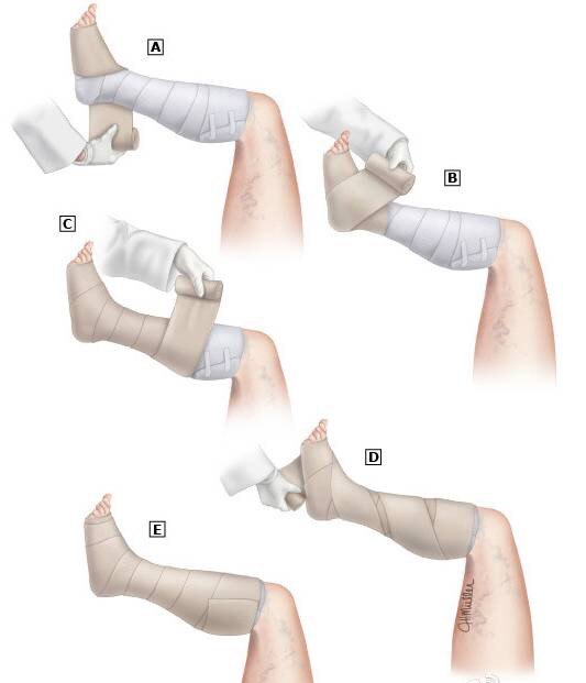 下肢弹力绷带包扎的方法.