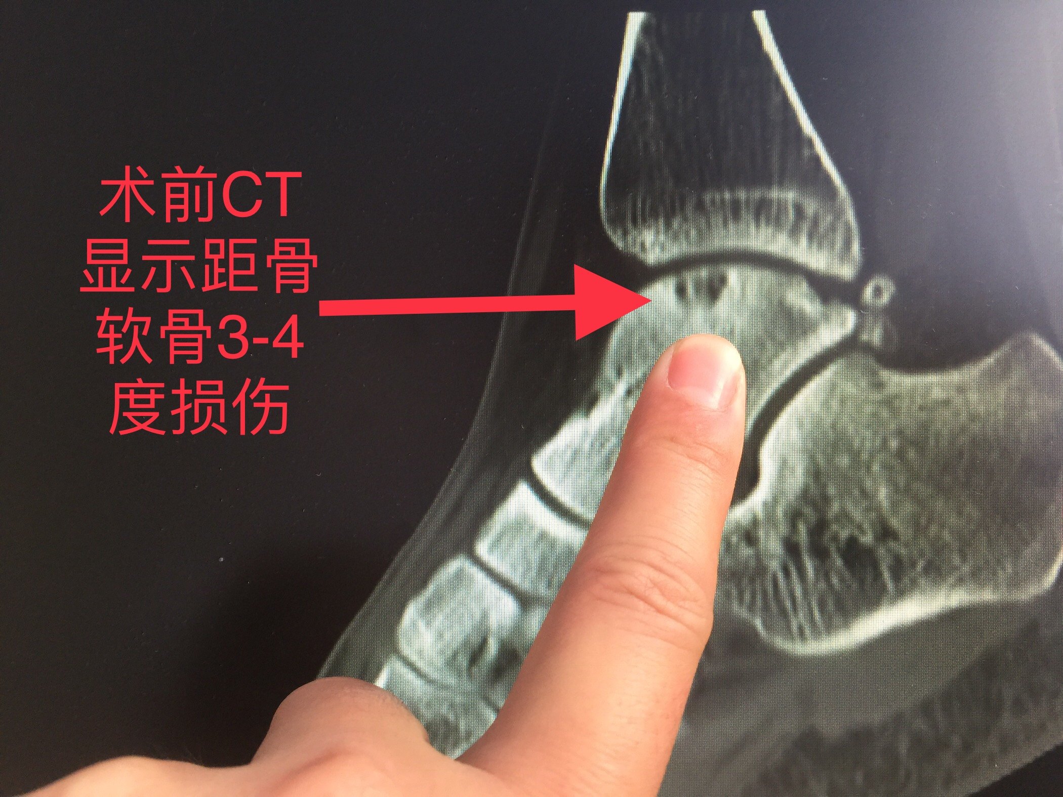 踝关节扭伤三月后出现距骨坏死!真可惜!