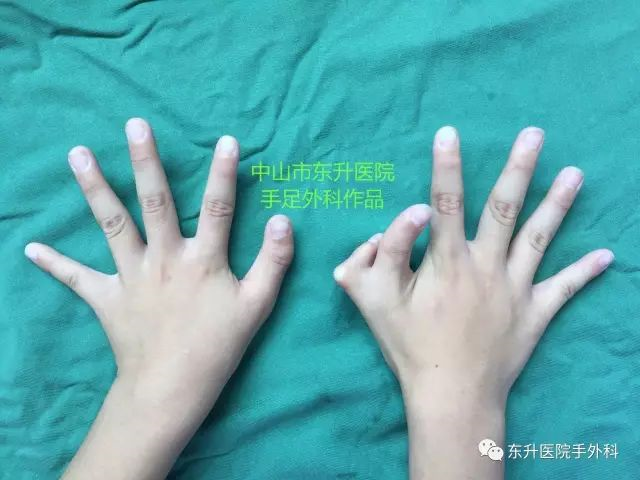 三节拇合并多指畸形矫正