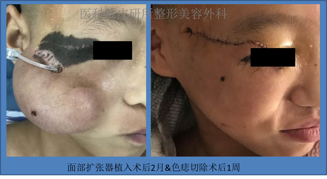 吴信峰 文章列表         先天性 色痣 的手术治疗包括直接切除,分次