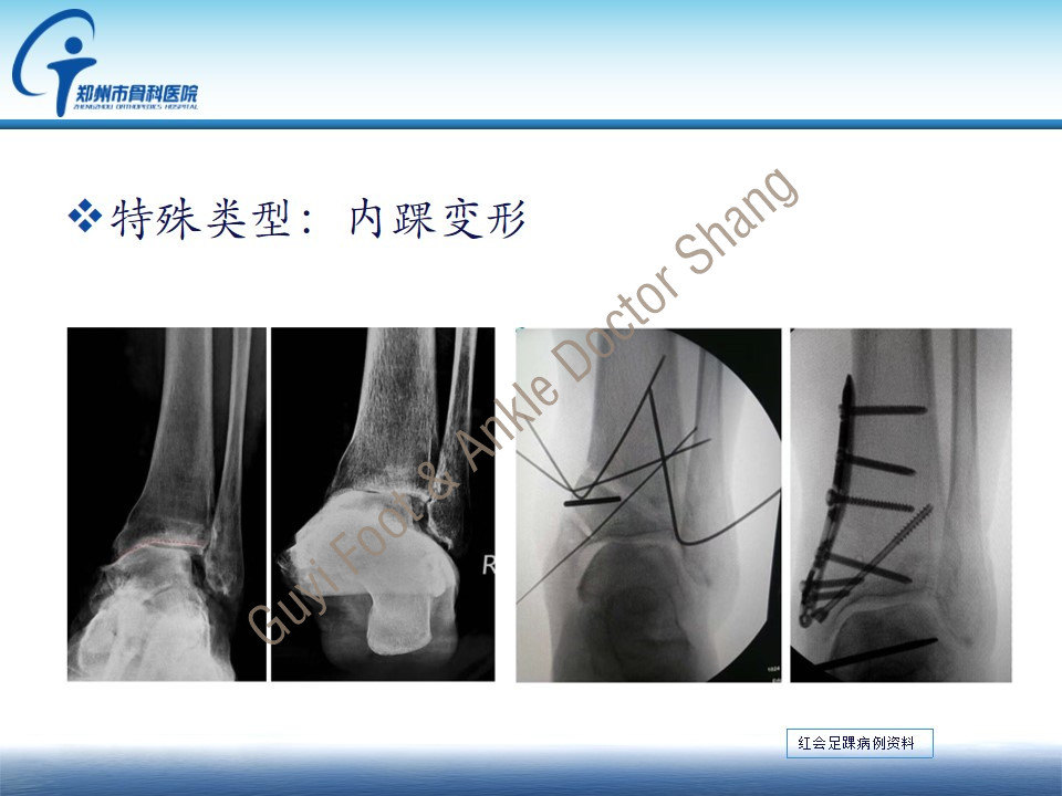 踝上截骨治疗内翻型踝关节炎