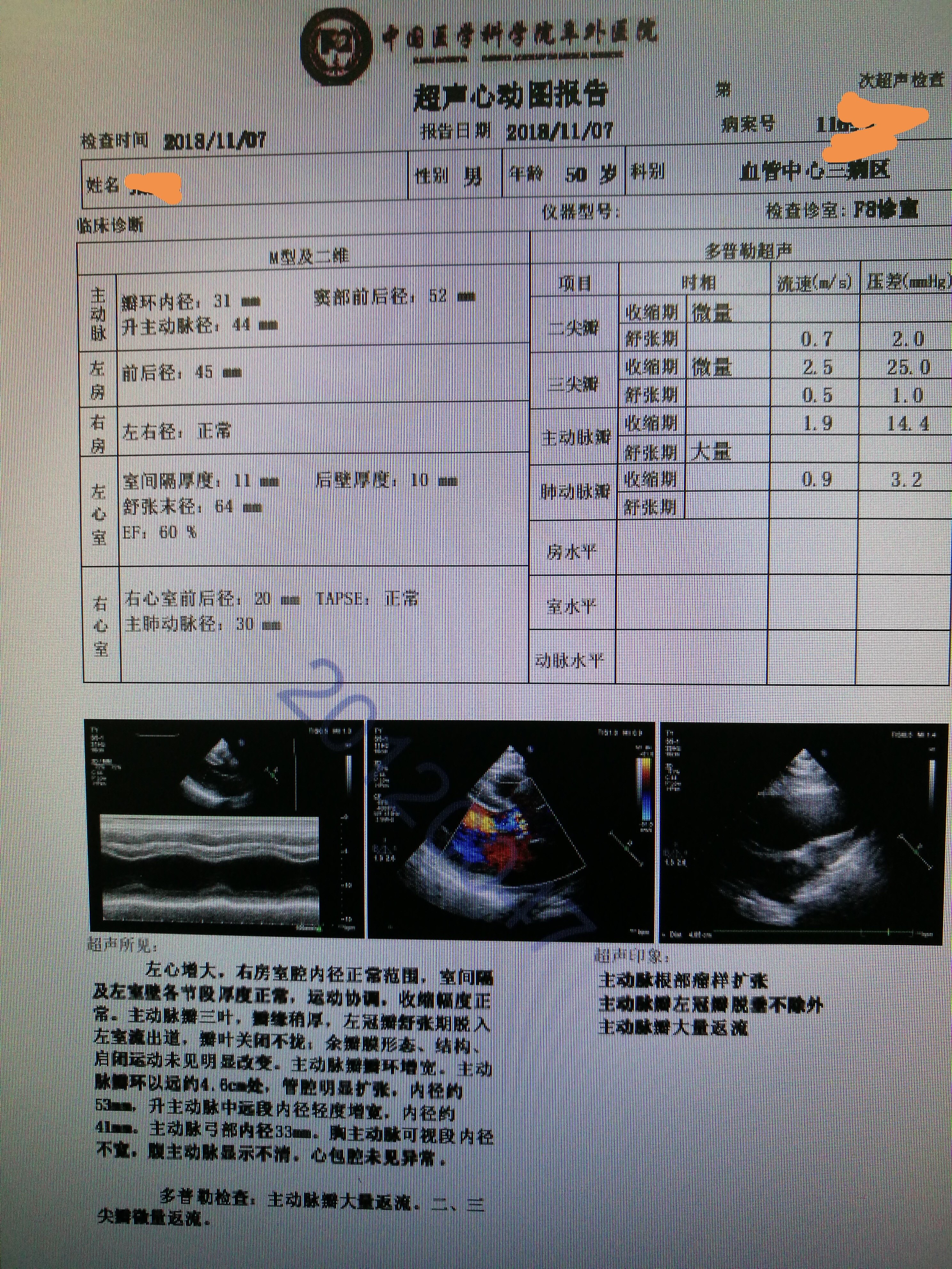 主动脉根部瘤合并主动脉瓣关闭不全典型病历1