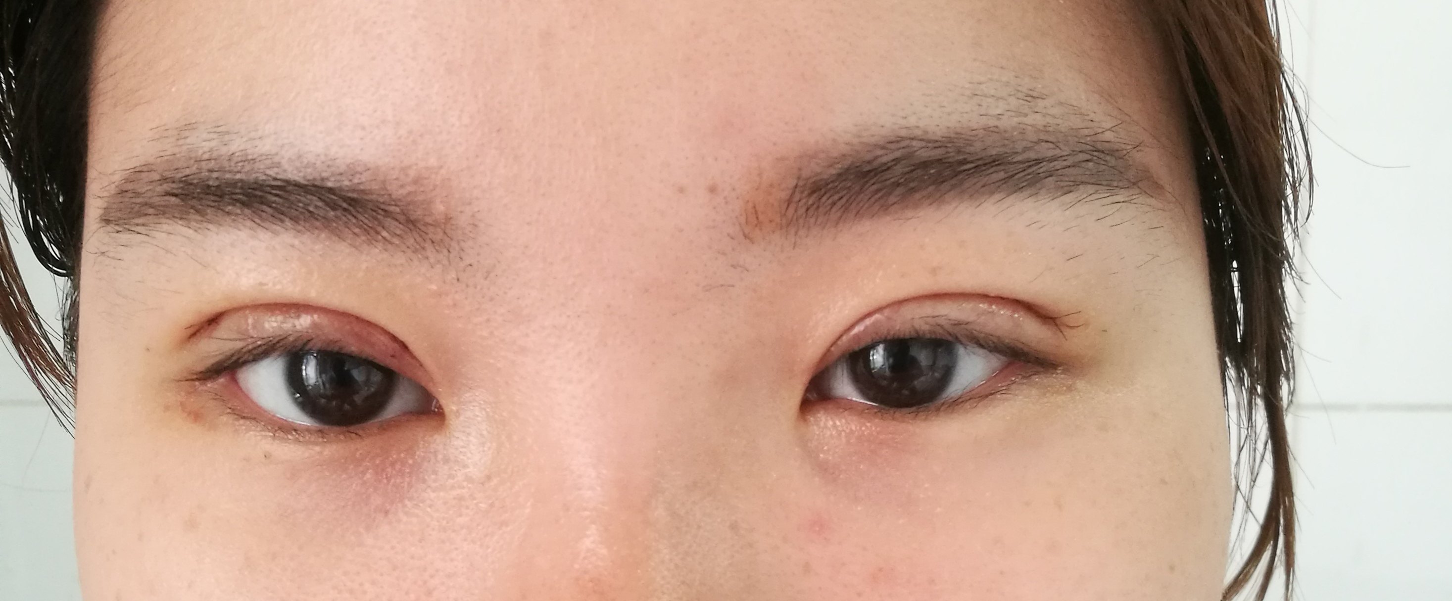 双眼皮术前术后案例分享