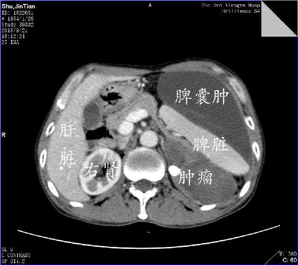 巨大节腹膜后肿瘤包裹脾脏手术切除获得圆满成功