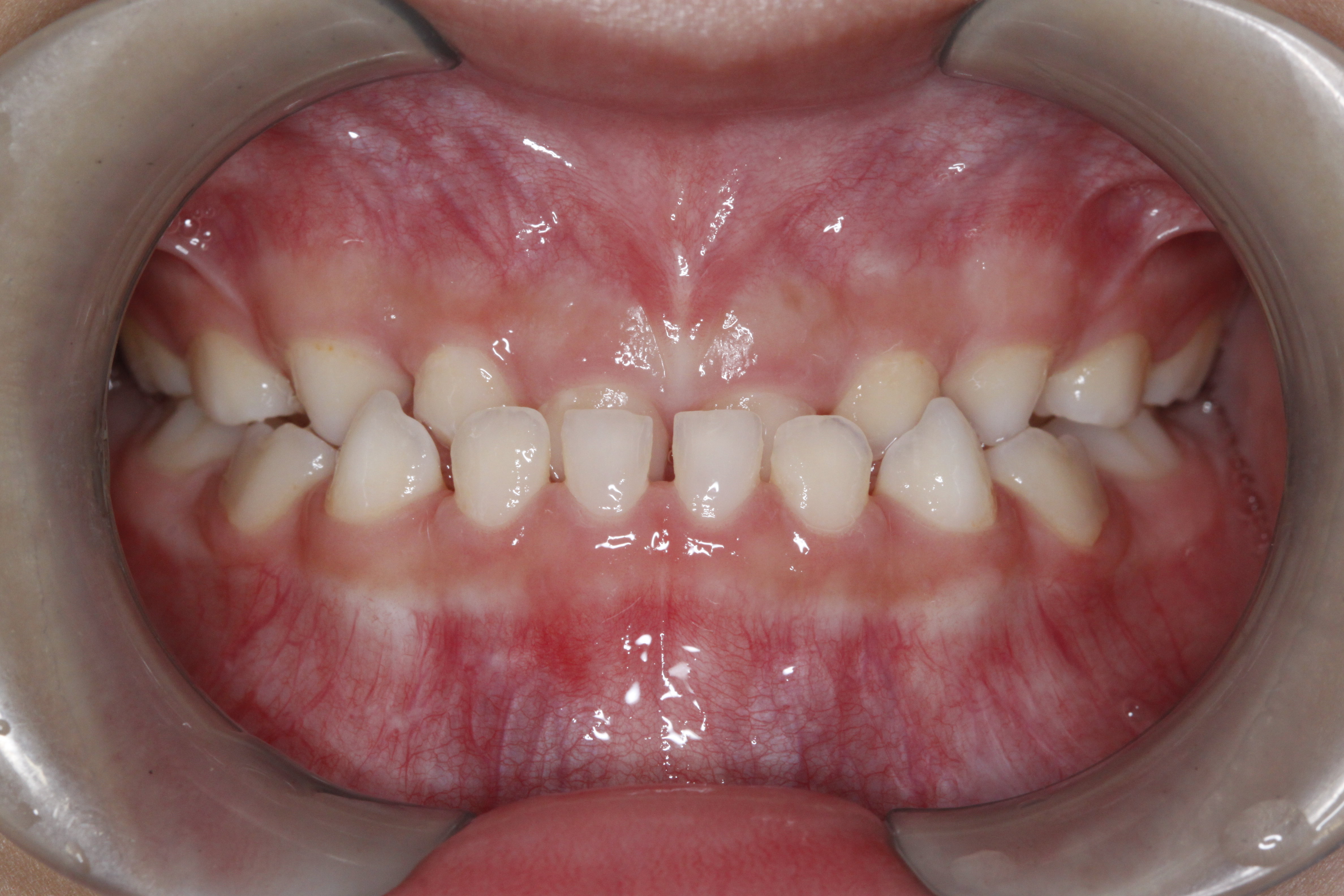 乳牙期反颌需早期矫治
