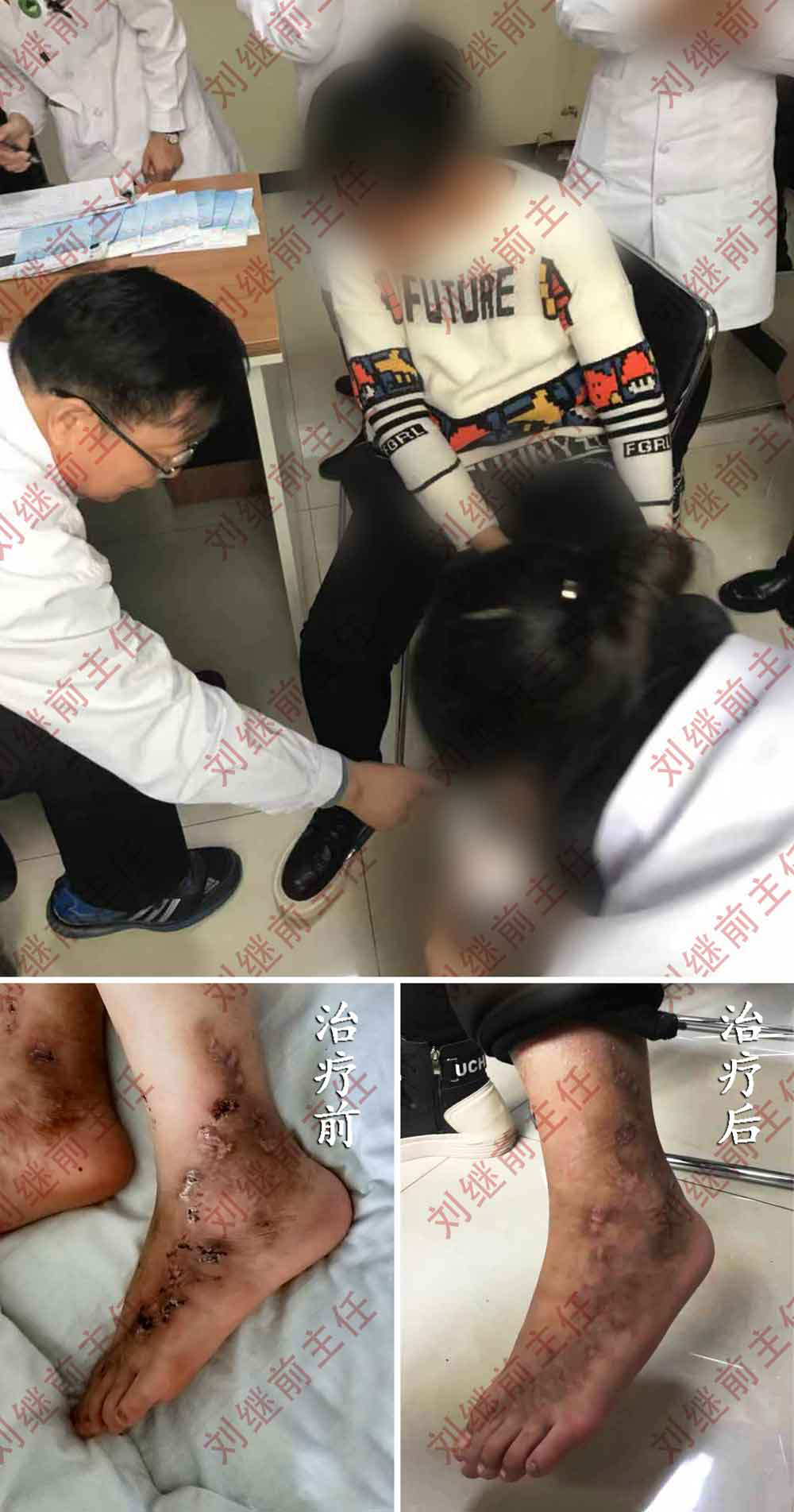 中医妙手挽救瓜藤缠花季少女双腿