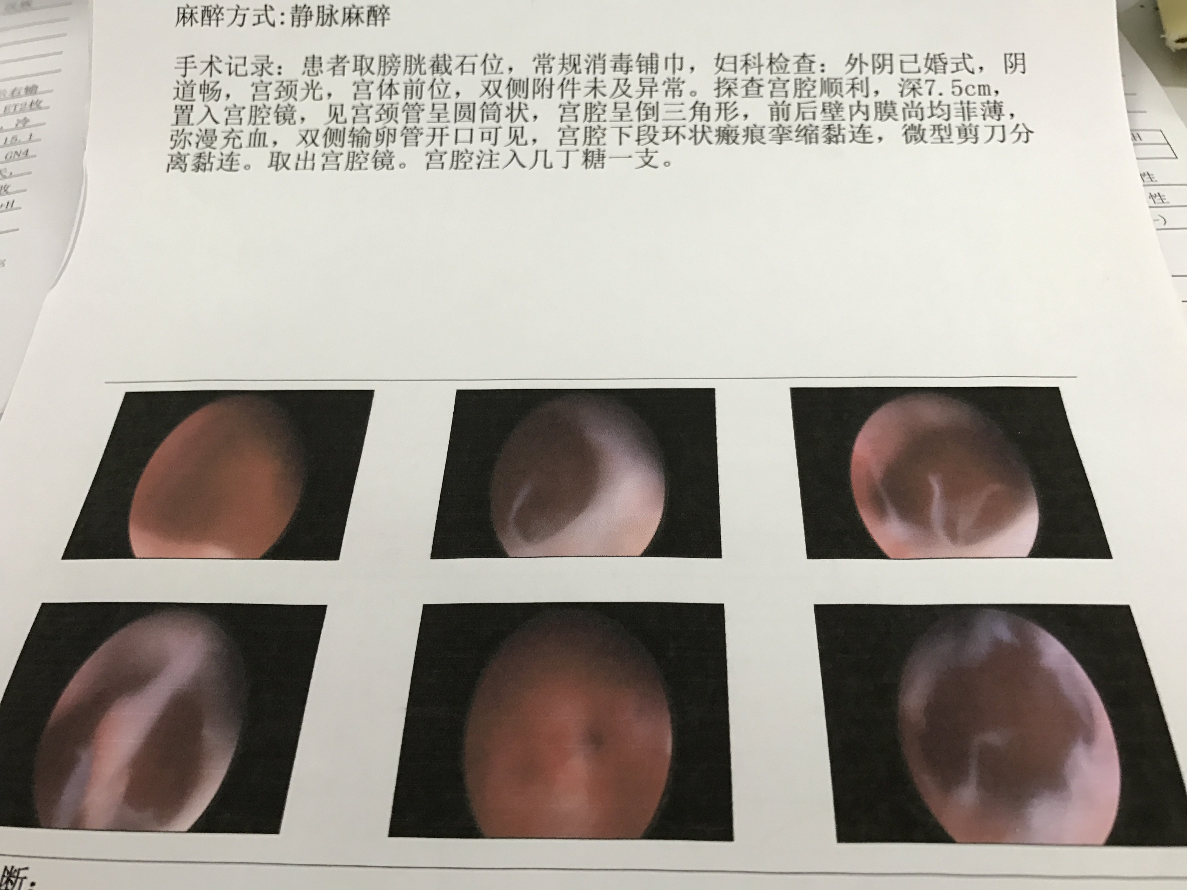 楼医生宫腔镜手术案例一