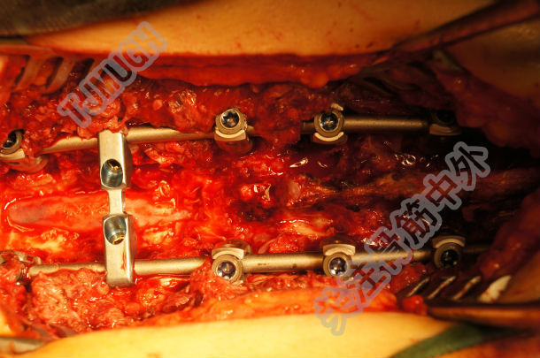 今日手术胸腰椎后路减压