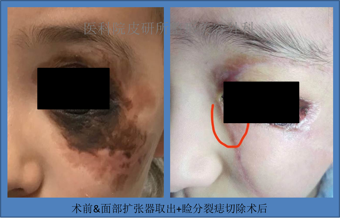 吴信峰 文章列表         先天性 色痣 的手术治疗包括直接切除,分次