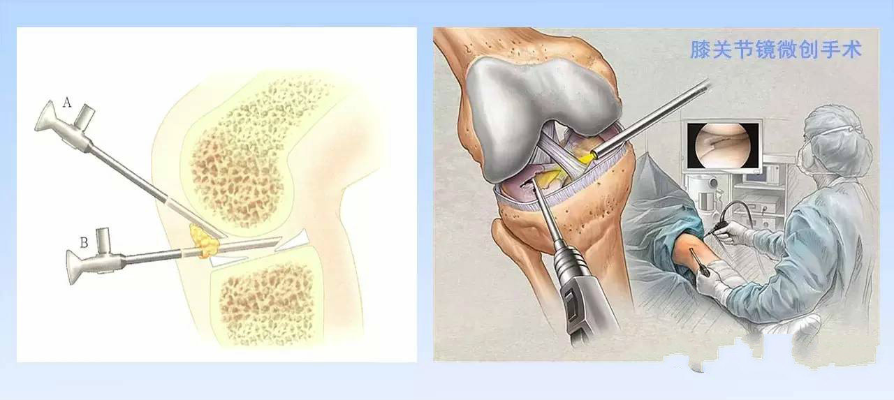 半月板切除哪些害处半月板保养的4个要点