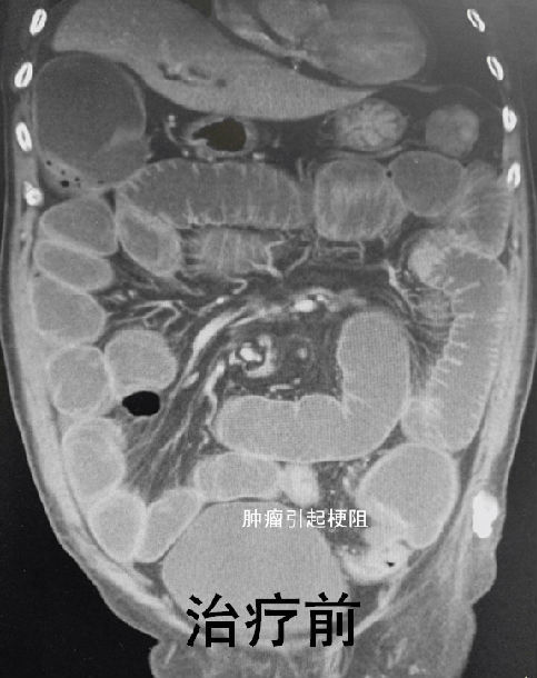 在院内开展急性肠梗阻的绿色诊疗通道,针对不同病因引起梗阻采取不同