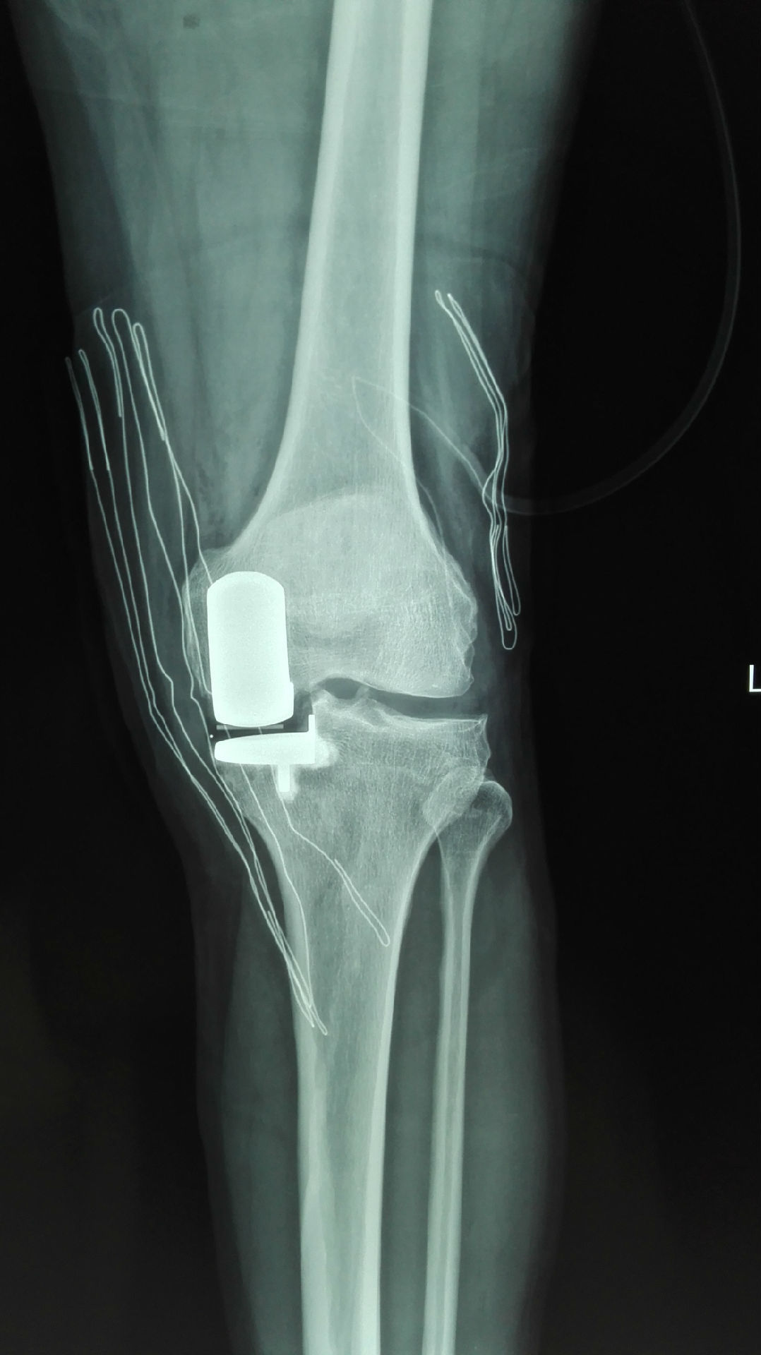 膝关节骨刺的微创治疗——部分膝关节置换术(单髁)