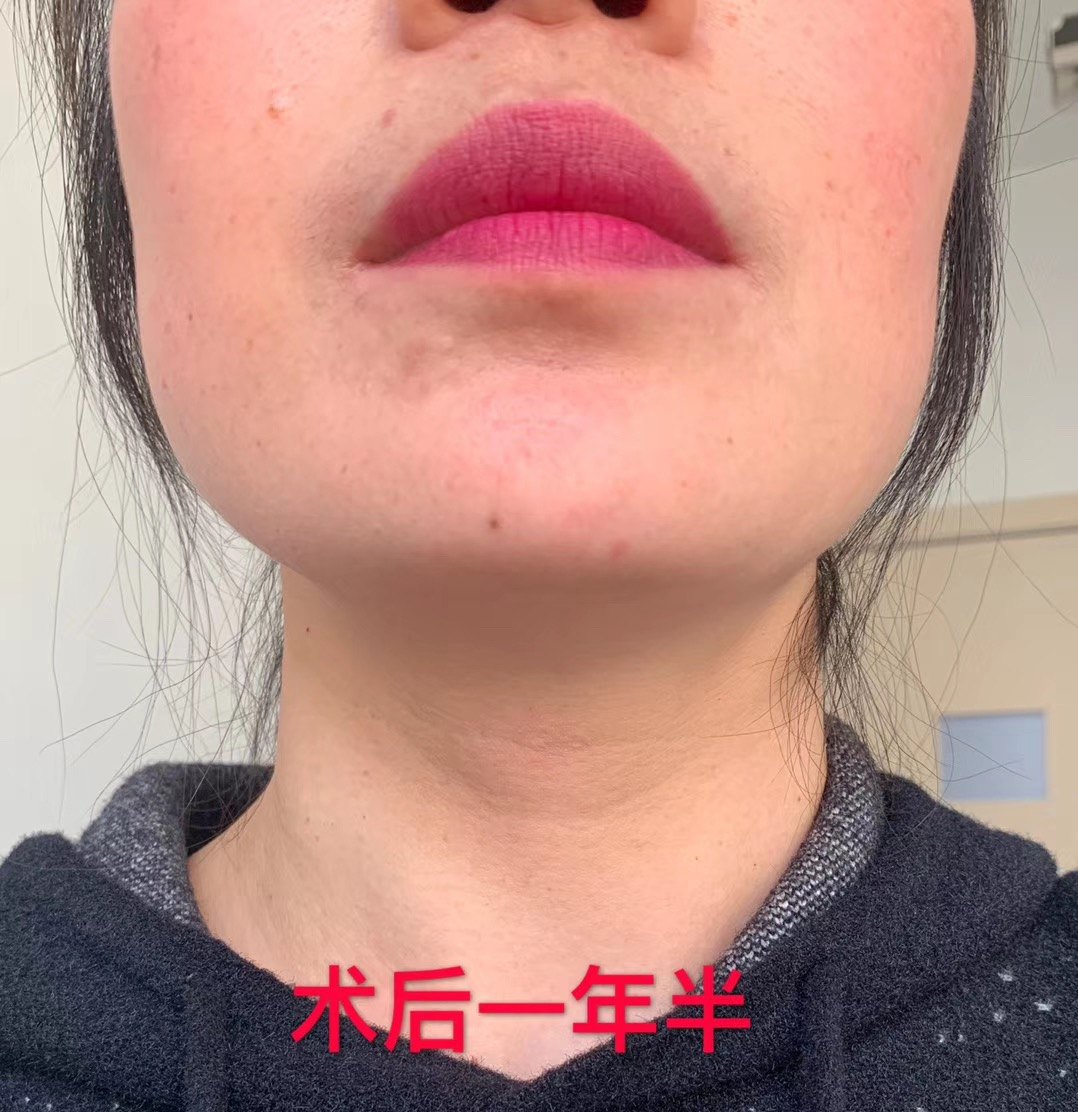 关于颈椎前路手术切口"美容"问题