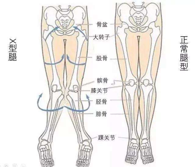 儿童o型腿及x型腿了解儿童膝内翻与膝外翻