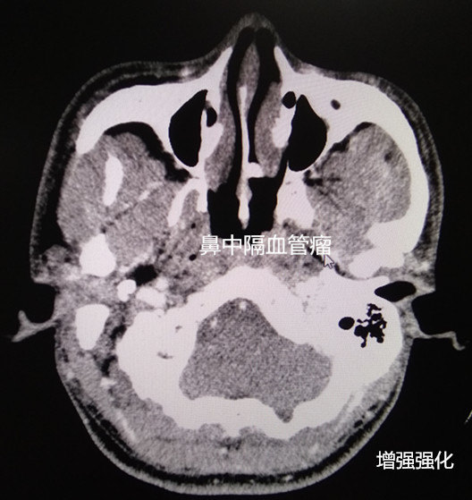 鼻血管瘤 - 好大夫在线