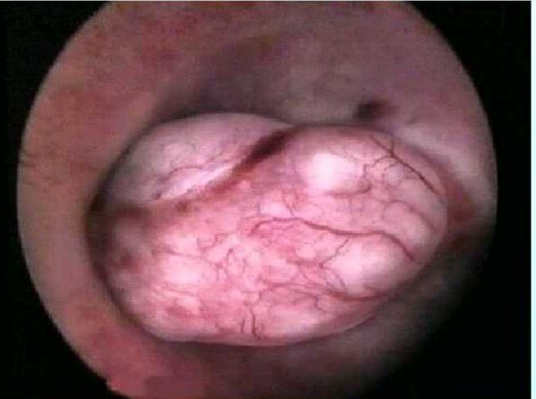 子宫粘膜下肌瘤切除 那么做宫腔镜前有什么