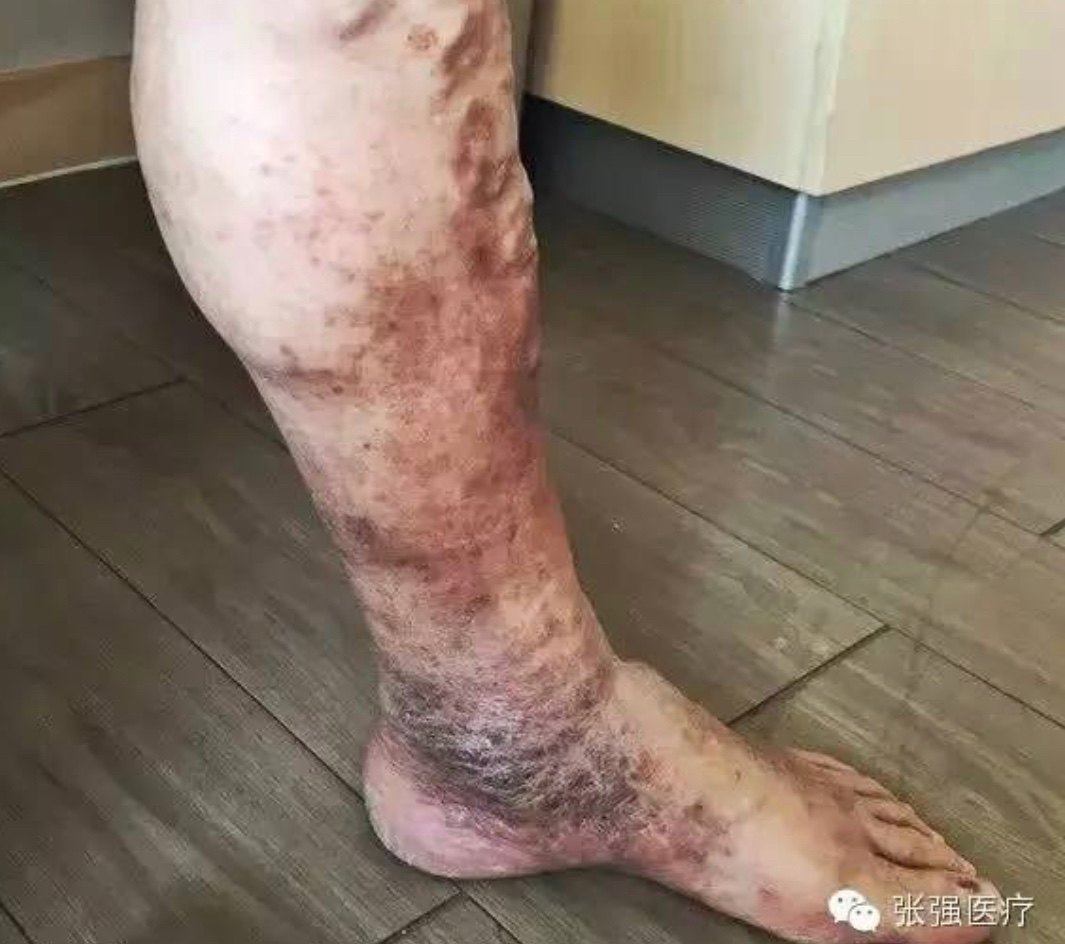 静脉高压导致红细胞由毛细血管渗出后破裂,铁红素在皮下沉积,使得皮肤