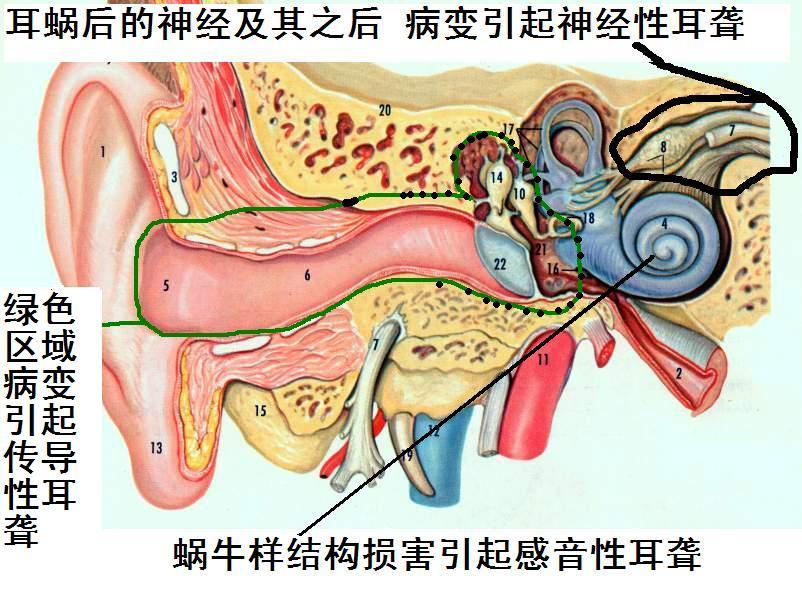 耳聋,神经性耳聋怎么分类?怎么治疗?效果如何?