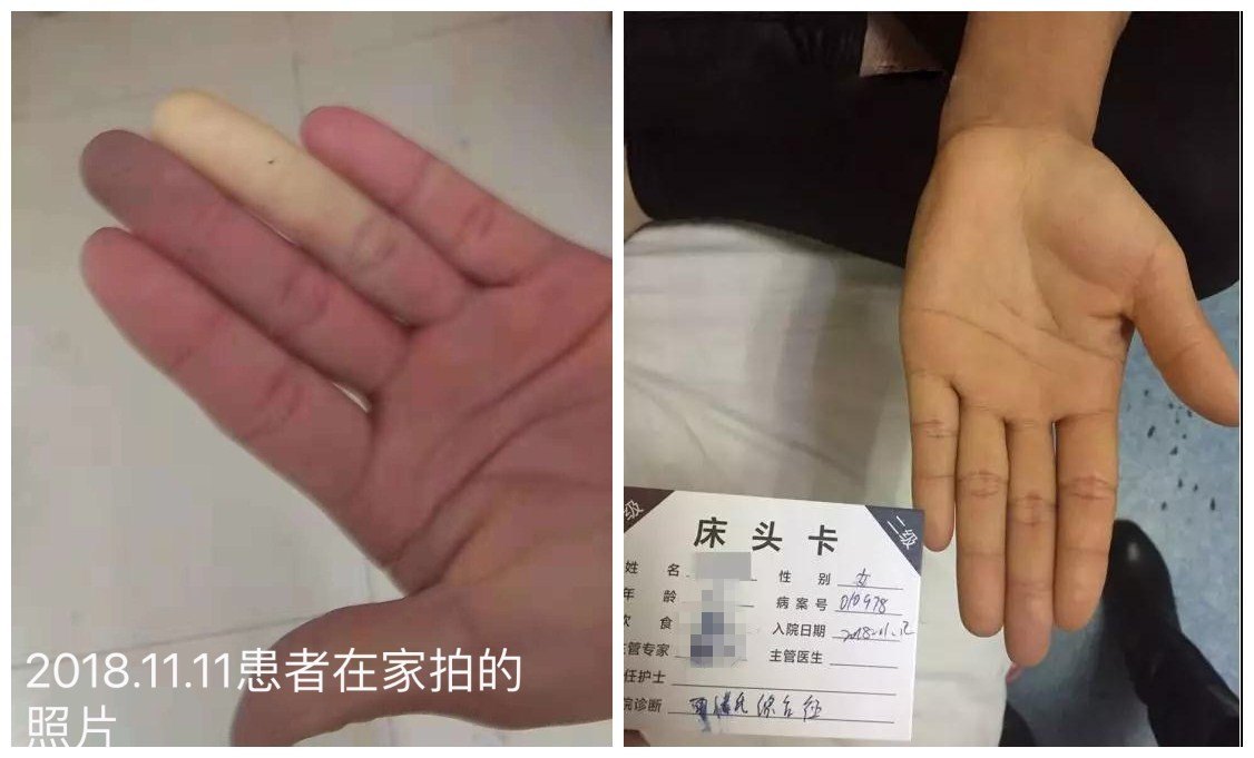 手指会变色,小心雷诺氏综合症