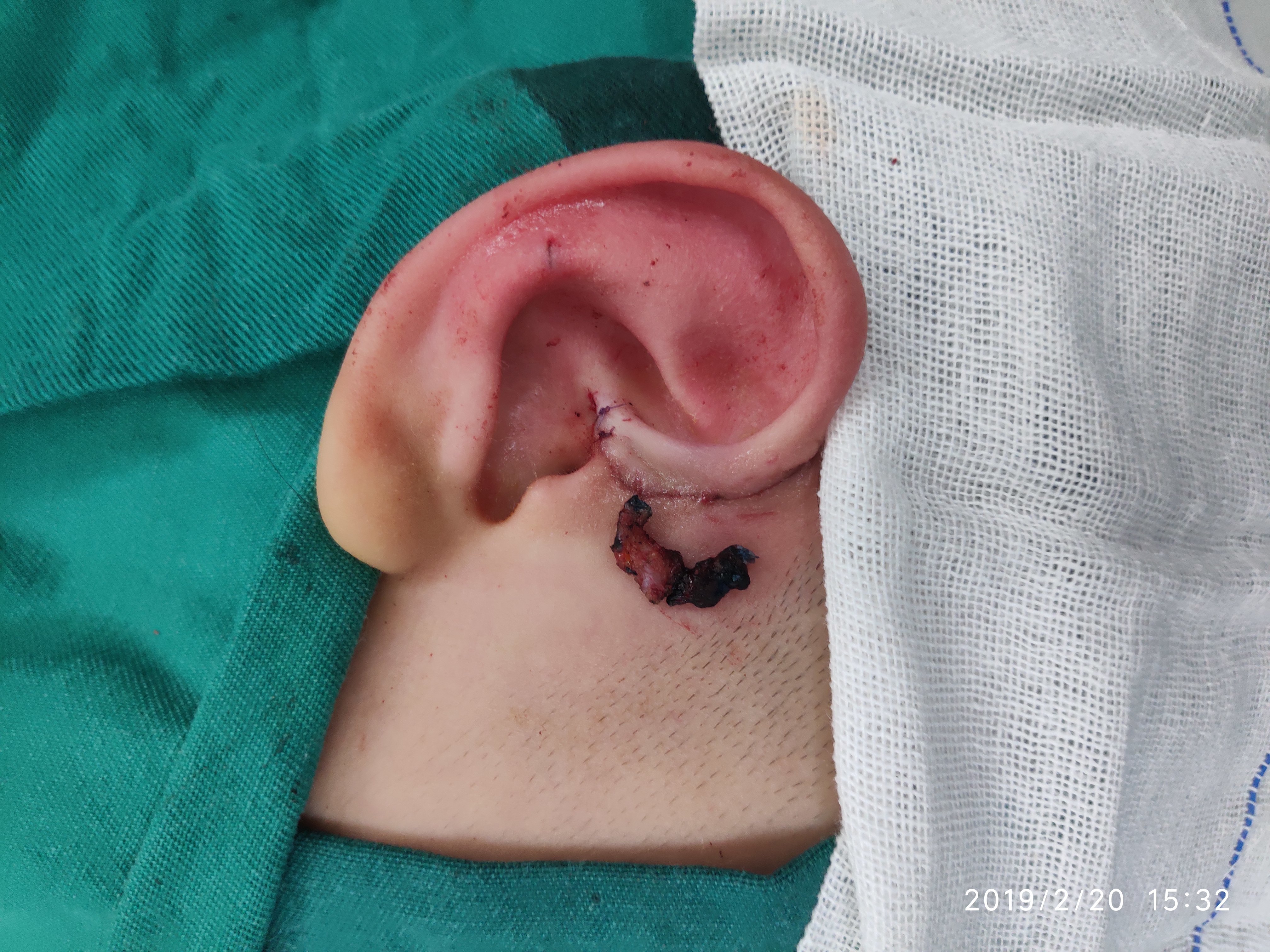 罕见双瘘口先天性耳前瘘管切除术