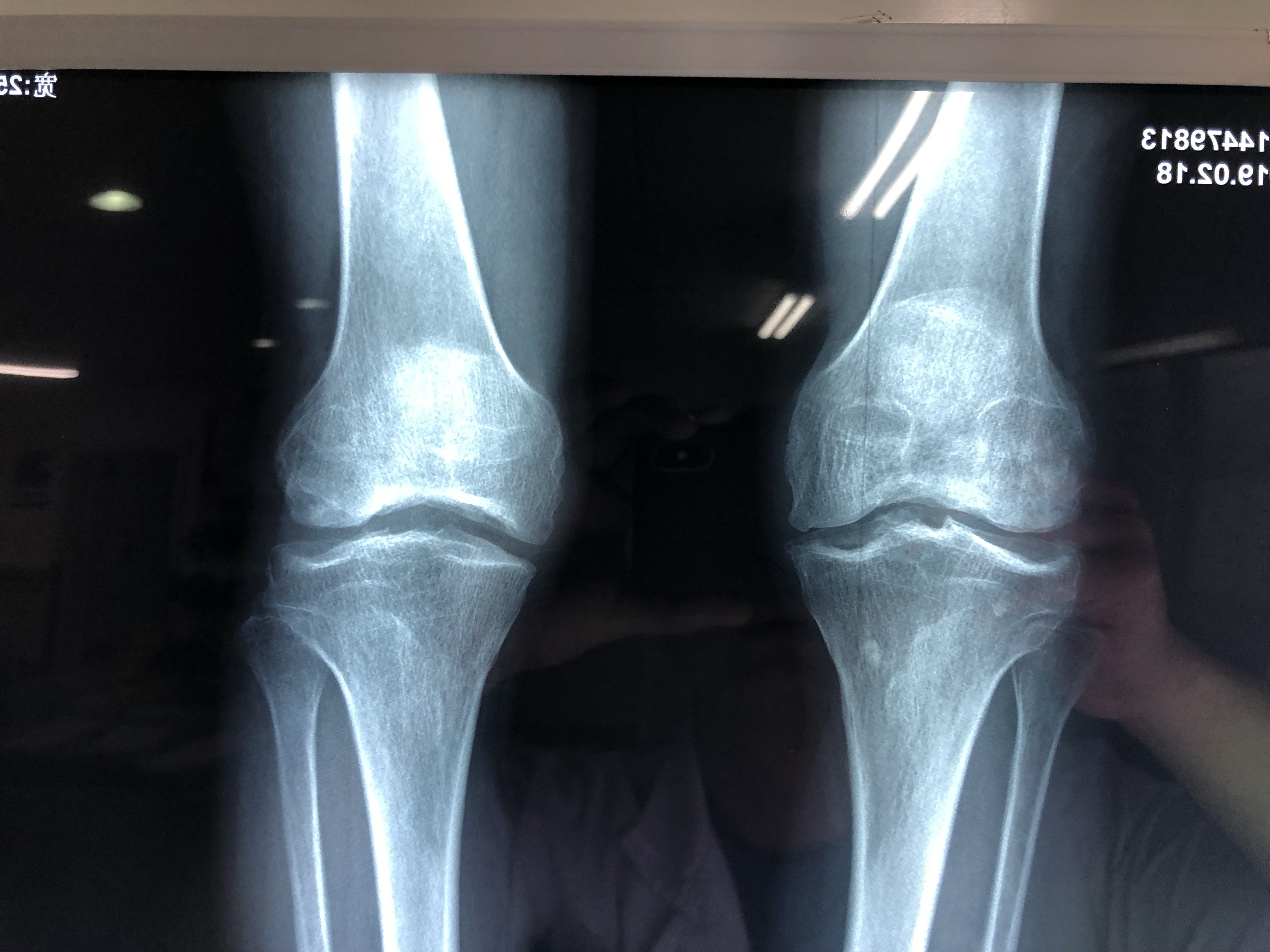 双膝骨性关节伴有半月板损伤中年男患,行关节镜术后