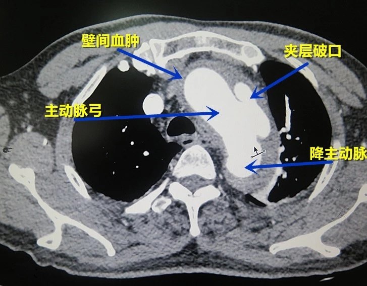 手术科普:主动脉瘤的外科治疗策略