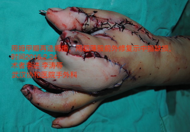 2.24成功完成一例手指再造合并皮瓣转移病例