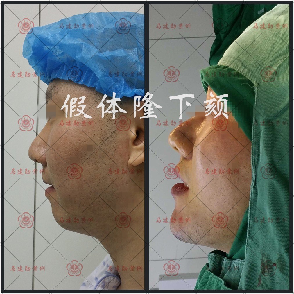 案例 假体隆下颏