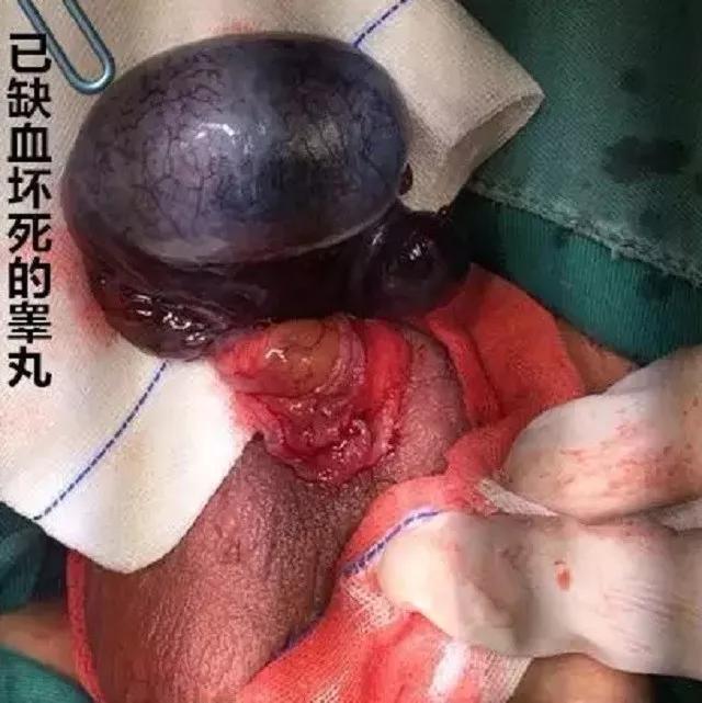 睾丸精索扭转,小心!