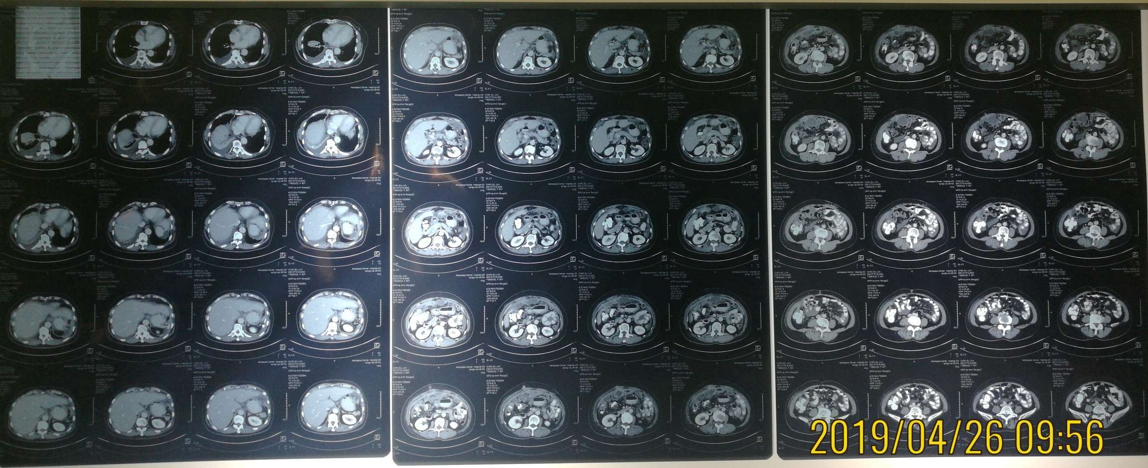 8主因超声发现腹水,未查肿瘤标志物,胃镜肠镜正常,ct提示大网膜结节