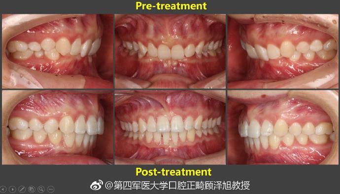 一例典型的内倾型深覆合病例