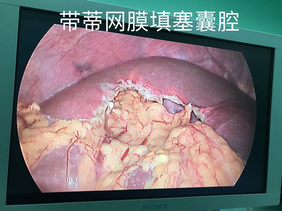 巨大肝囊肿的微创治疗之腹腔镜肝囊肿开窗