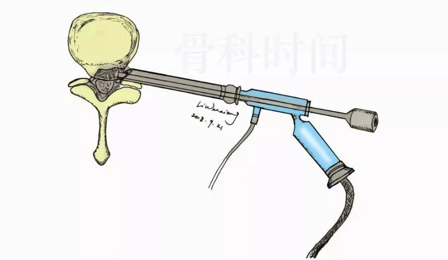 最全图解椎间孔镜治疗腰椎间盘突出症