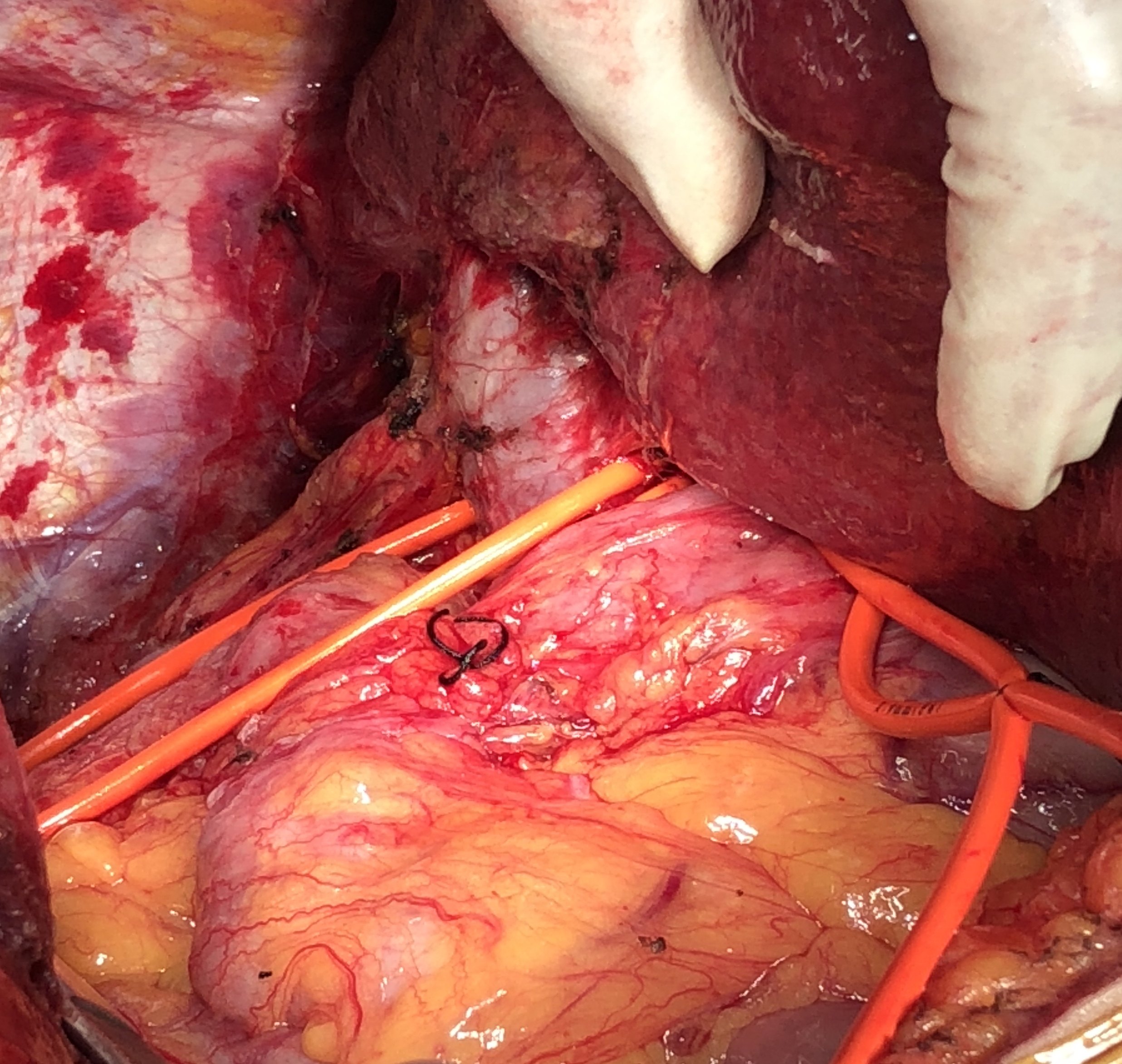 胆管癌食谱 这篇综述着重于ICC治疗的当前和未来策略(组图)