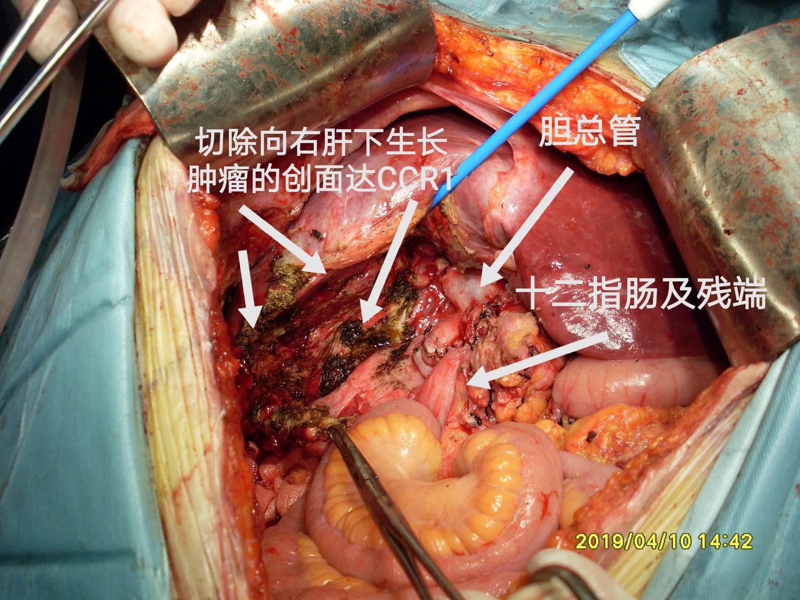 病例(40-结肠肝曲粘液腺癌突破肠管向外生长!