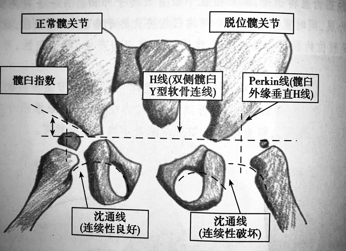 图说正常髋关节和脱位髋关节 (原创)