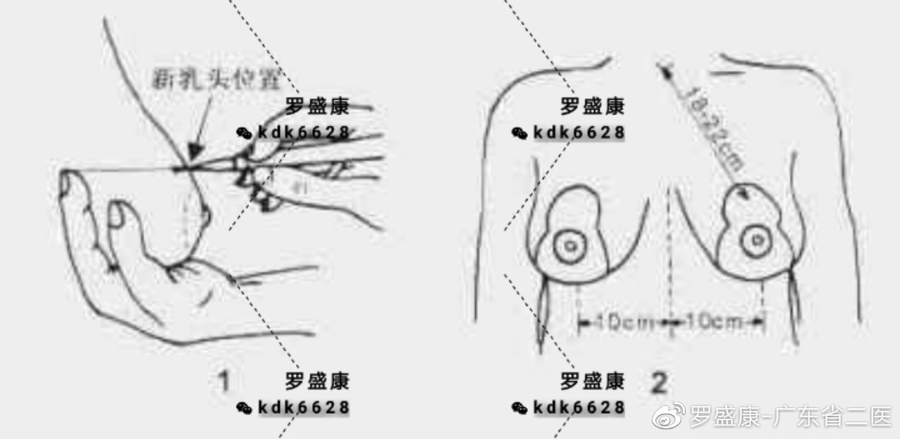 乳房下垂悬吊术