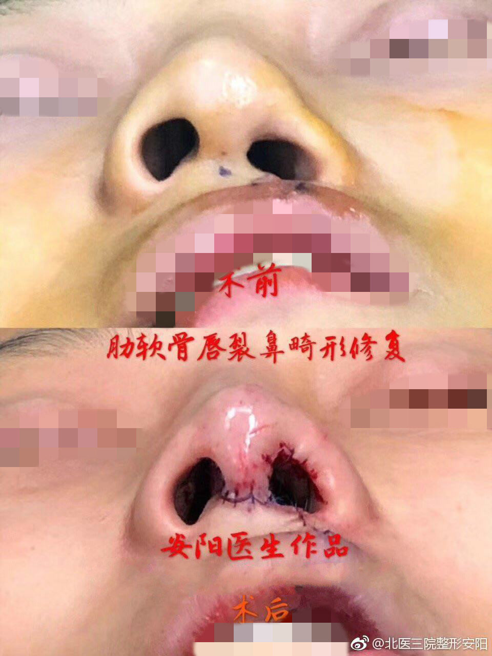安阳 文章列表  今日份案例分享: 用户术前: 唇裂 鼻畸形 手术方案:全