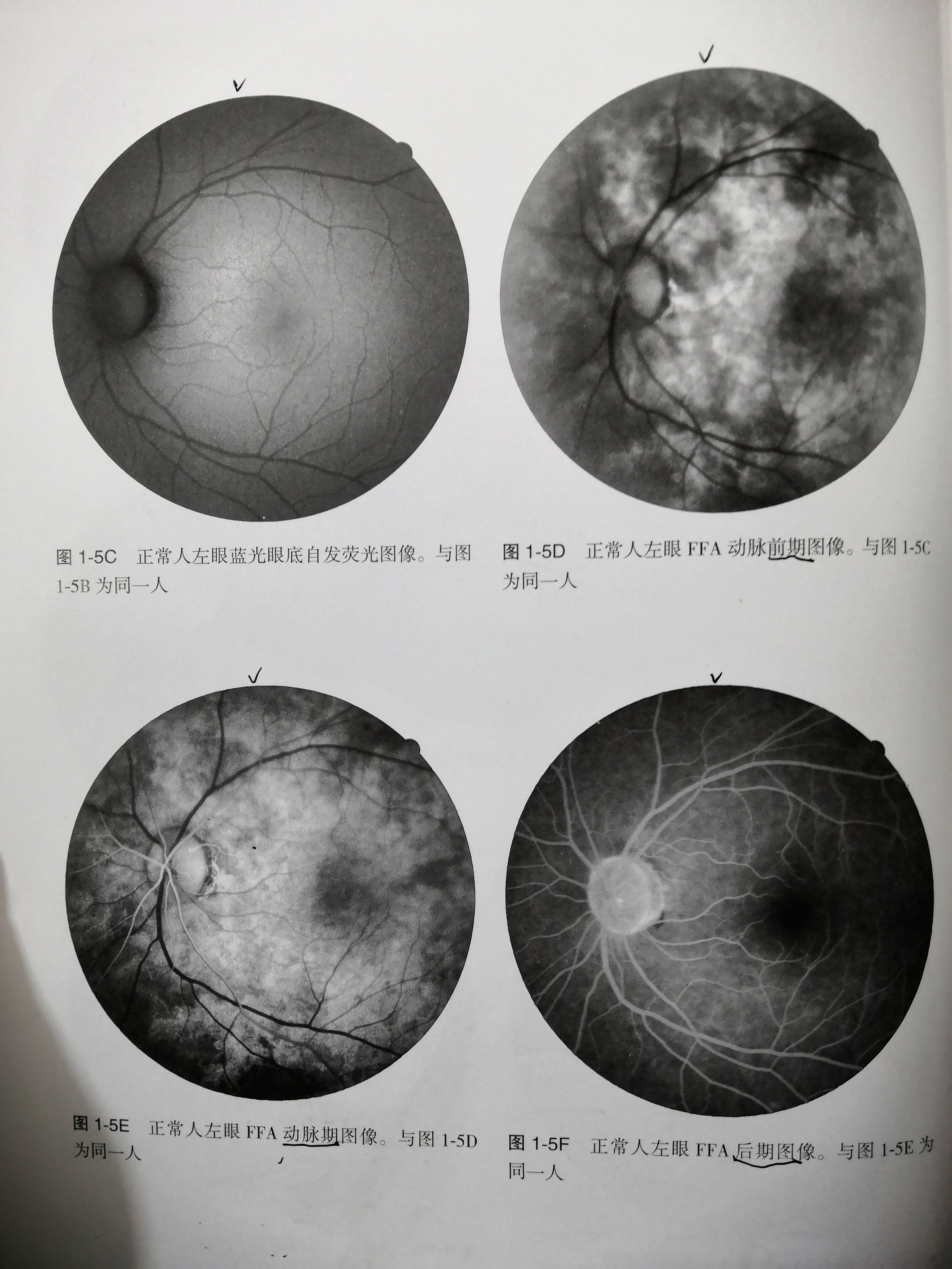 眼底荧光血管造影各期的图片