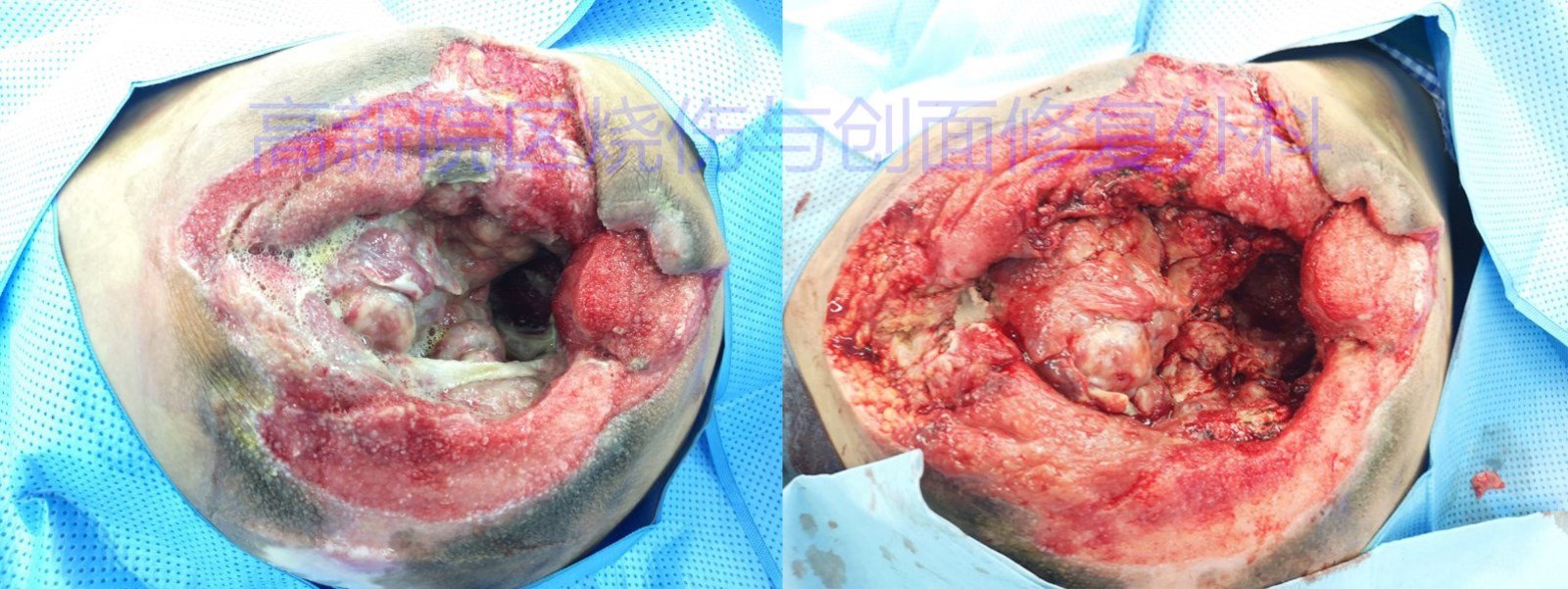 多学科协作,高新院区治愈巨大褥疮患者!