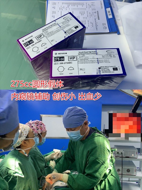 双平面假体隆胸手术,15秒精准植入275cc乳房假体!