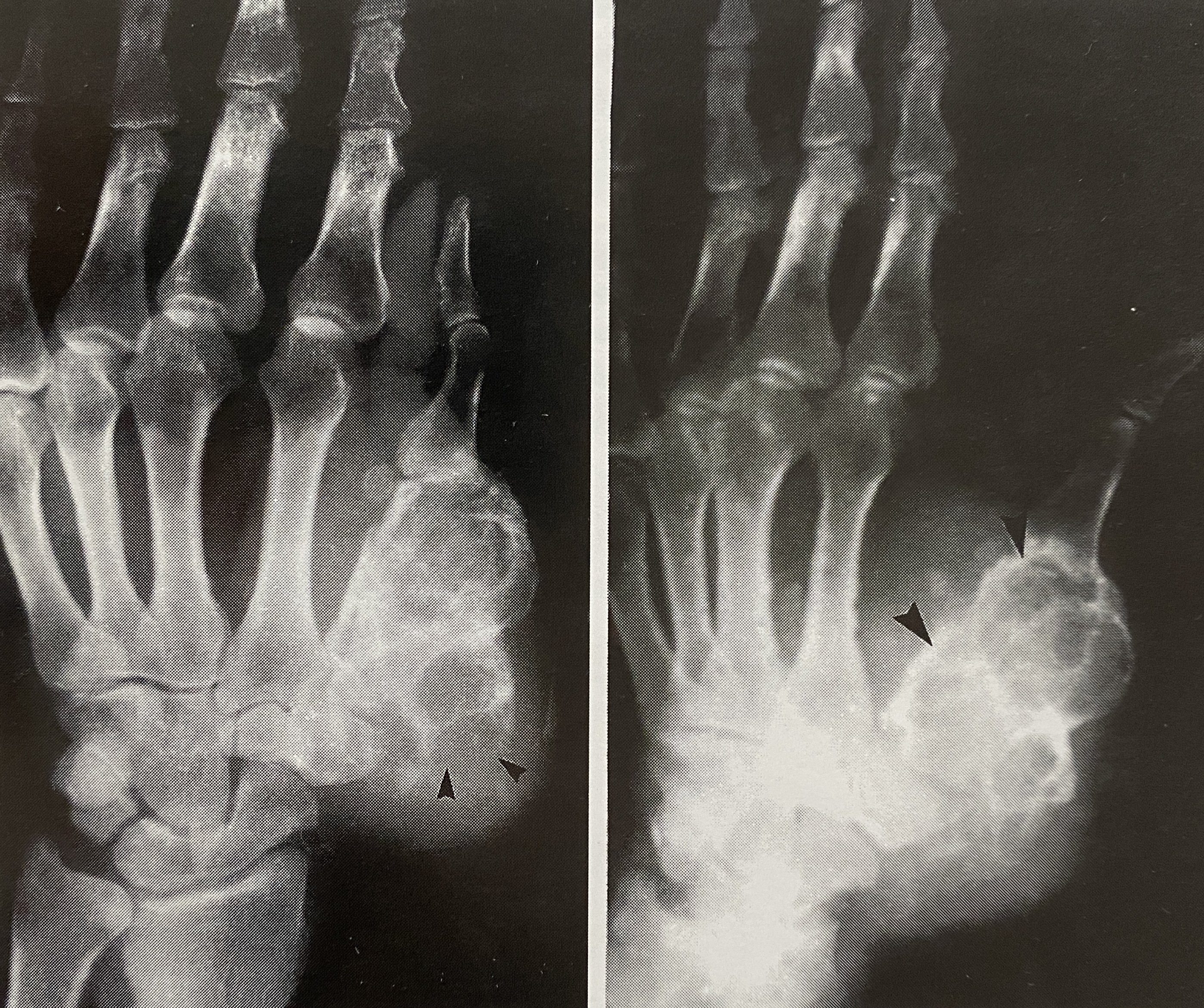 软骨黏液样纤维瘤x线平片示左手拇指第1掌骨多囊状膨胀性骨破坏,破坏
