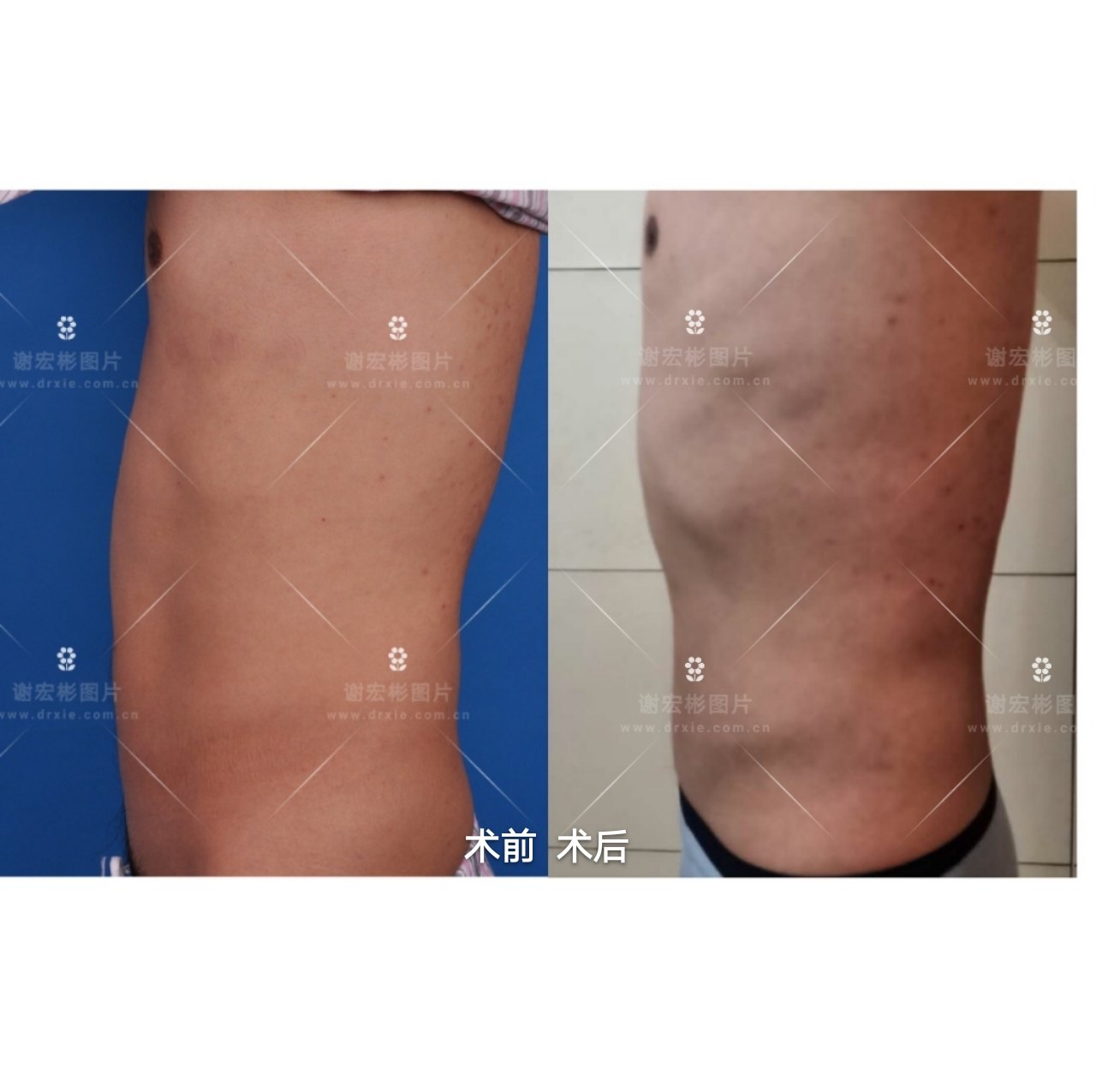 男性腹部吸脂,露出马甲线