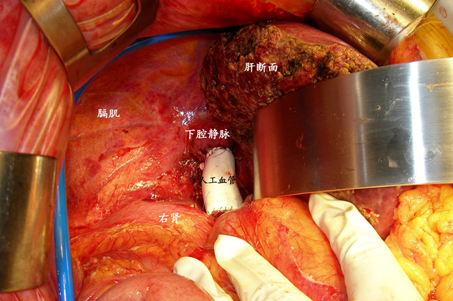 我科刘超副院长再次完成联合下腔静脉切除重建的高难度肝癌手术