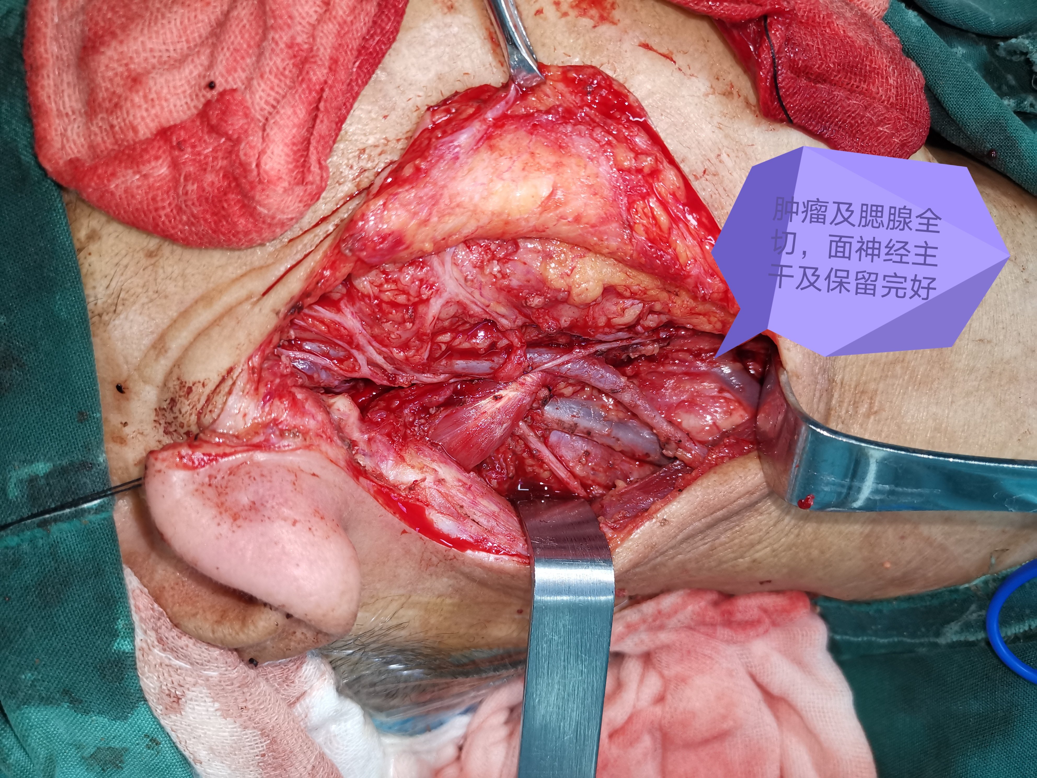 腮腺常见的恶性肿瘤,治疗以手术彻底切除为主,并同期清扫区域淋巴结