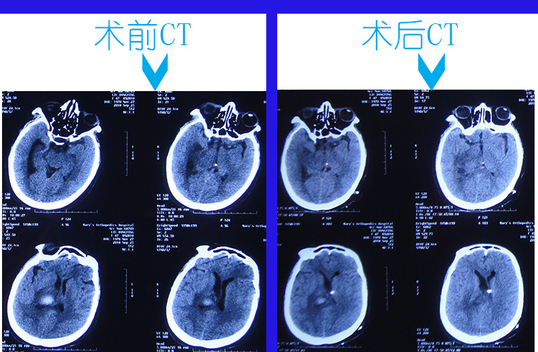完全偏瘫性破入脑室内丘脑出血脑室引流又致反复3次难治性颅内感染和