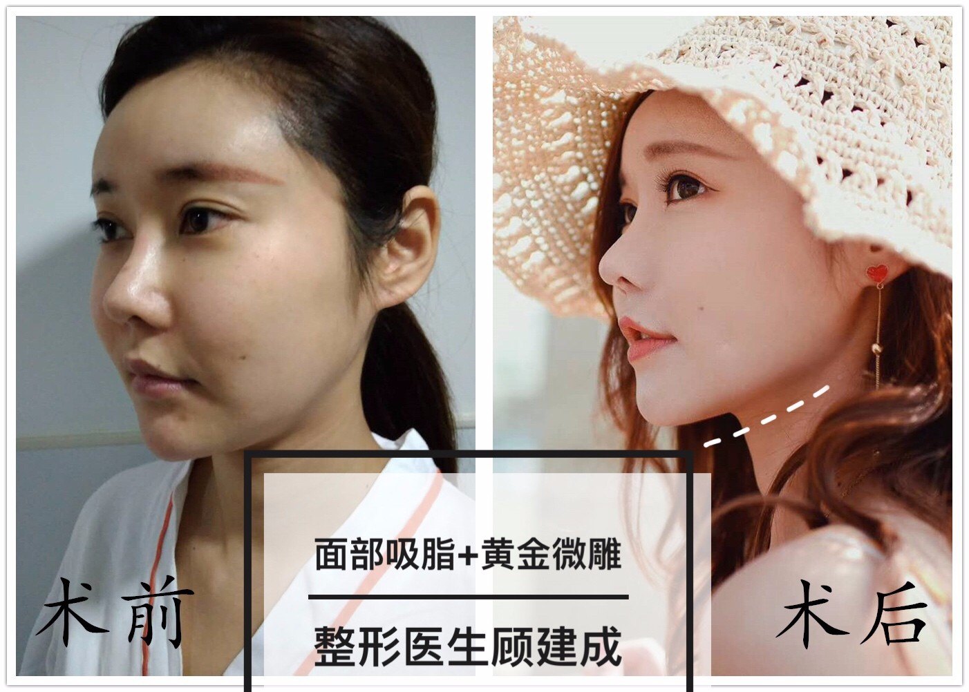 面部吸脂后多久可以看到效果?