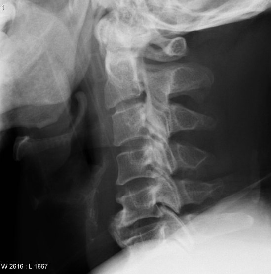 颈椎后纵韧带骨化症的临床表现